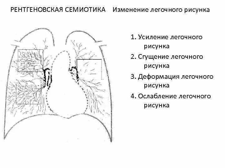 Усиленный в базальных отделах. Сгущение легочного рисунка рентген. Рентген легких усиление легочного рисунка. Сгущение легочной ткани на рентгене. Синдром усиленного легочного рисунка.