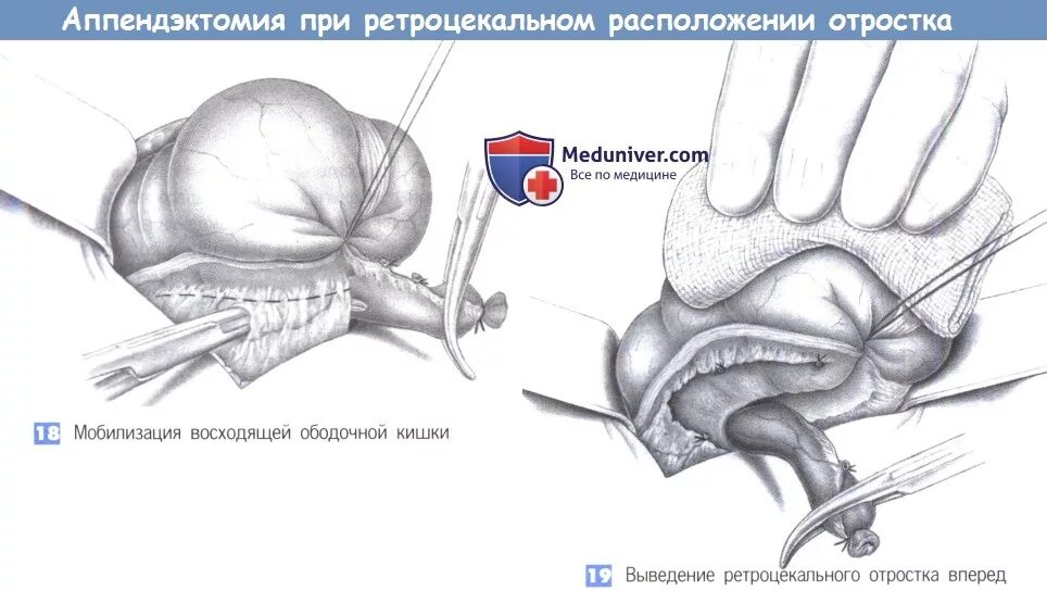 Аппендэктомия при ретроцекальном аппендиците. Операция при ретроцекальном аппендиците. Этапы операции аппендэктомии. Аппендэктомия техника операции.