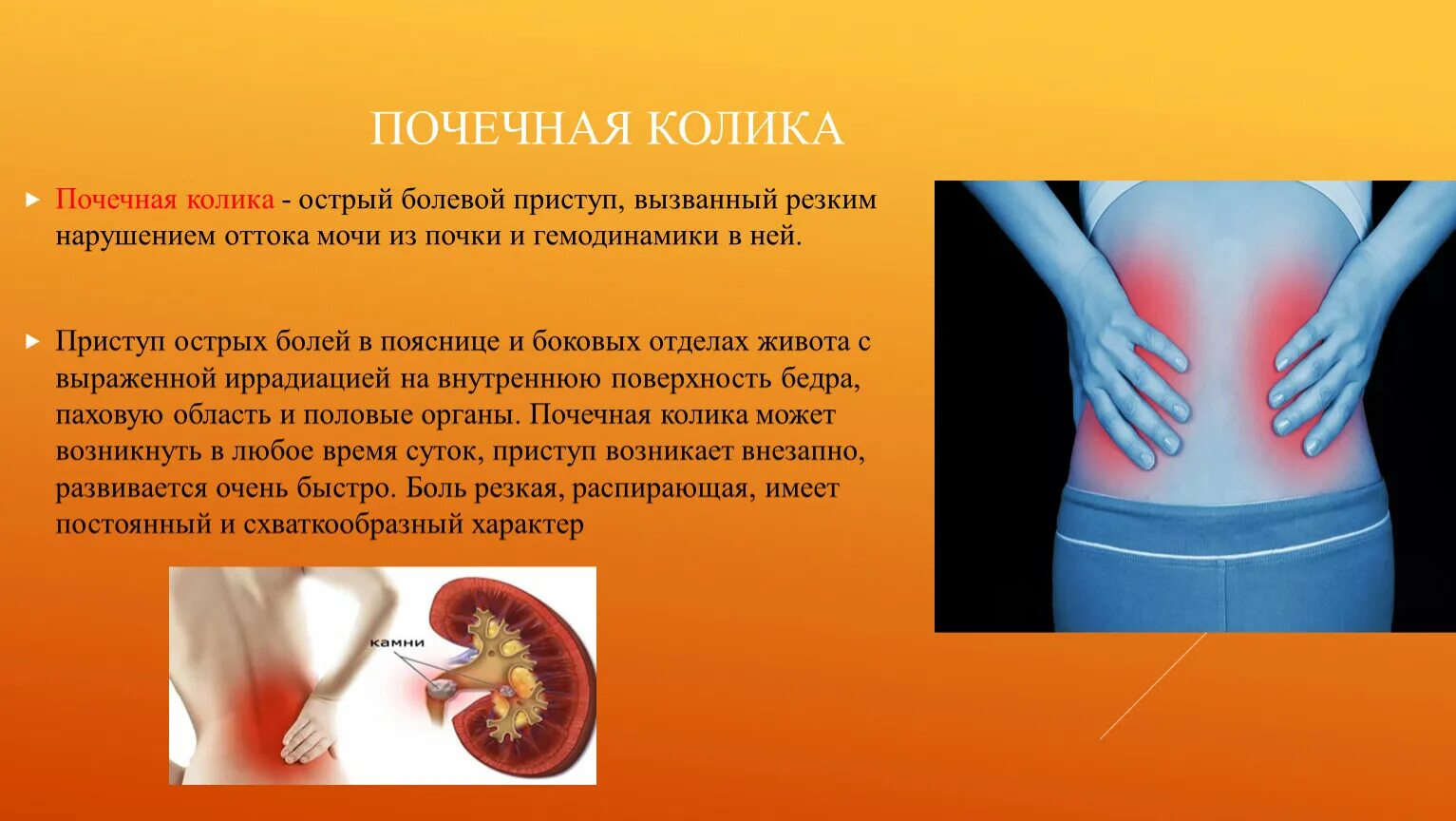 Какая боль при почках у женщин симптомы. Клинические симптомы почечной колики. Заболевание почек почечная колика. Мочекаменная болезнь почечная колика. :Мочекаменная болезнь,почечный коллек.