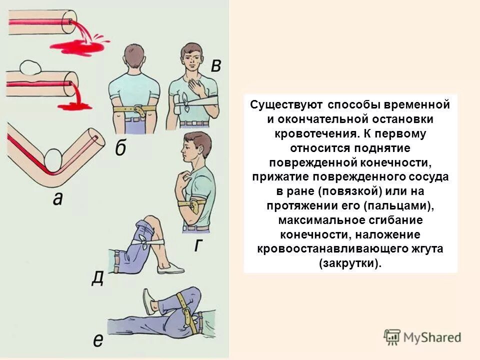 Способы остановки кровотечения. Остановка кровотечения наложение повязки. Способы остановки кровотечения при травме конечностей. Остановка кровотечения методом максимального сгибания. Повреждение мелких артерий кистей и стоп