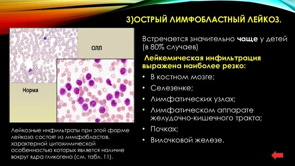 Лимфобластный лейкоз у взрослых. Острый лимфобластный лейкоз. Лимфобластный лейкоз в2 клеточный. Острый макро лимфобластный лейкоз. L2 лимфобластный лейкоз.