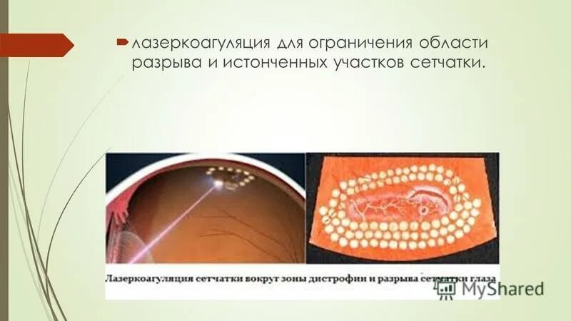 Ограничение после лазерной коагуляции сетчатки. Ограничение после лазерной коагуляции сетчатки