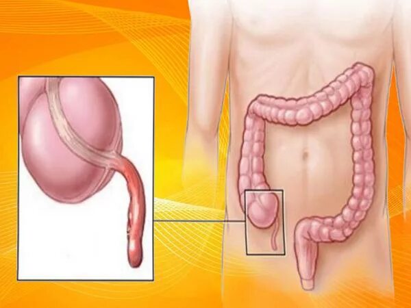 Стул при аппендиците. Катаральный аппендицит. Флегмонозный аппендицит. Острый поверхностный аппендицит. Острый катаральный аппендицит.