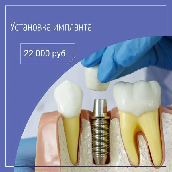 Протезист спб. Стена в стоматологии. Зубные импланты как устанавливают. Глинстен стоматология.