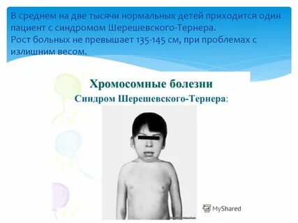 Симптомы шерешевского тернера