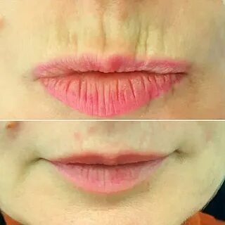 Филлеры кисетные