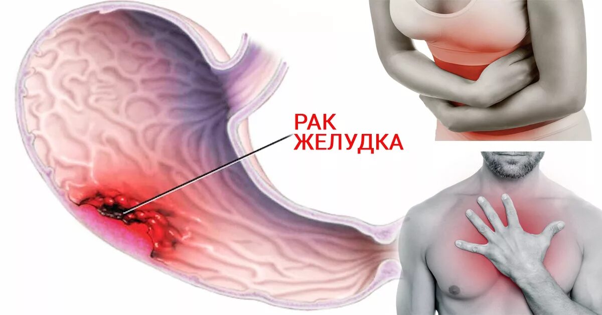 Рак желудка первые форум. Онкология желудка симптомы. Злокачественное новообразование желудка. Опухолевые заболевания желудка.