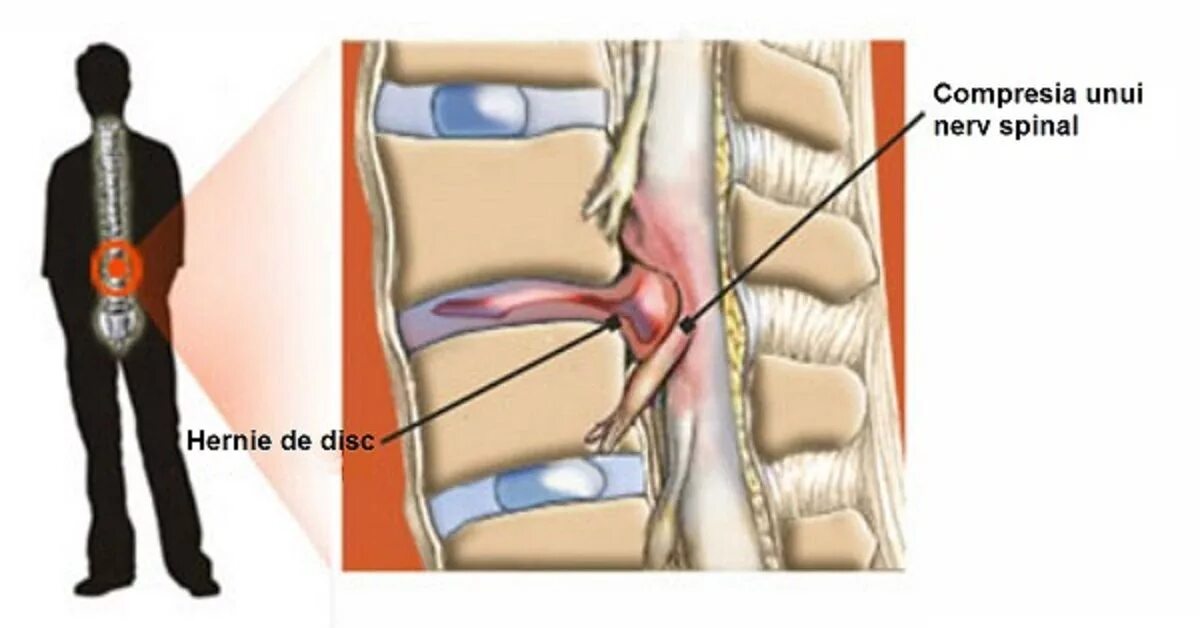 Болит нога после операции грыжи позвоночника. Грыжа межпозвоночного диска корешки. Межпозвоночная грыжа грыжа поясничного отдела. Операция грыжи пояснично-крестцового отдела позвоночника.