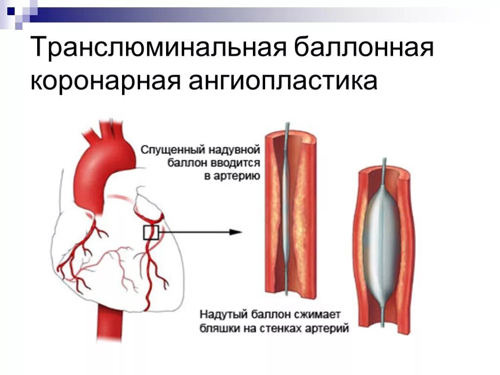 ТРАНСЛЮМИНАЛЬНАЯ ангиопластика коронарных артерий. Баллонная ангиопластика и стентирование. Баллонная ангиопластика сосудов сердца. Эндоваскулярное стентирование. Операции коронарных артерий