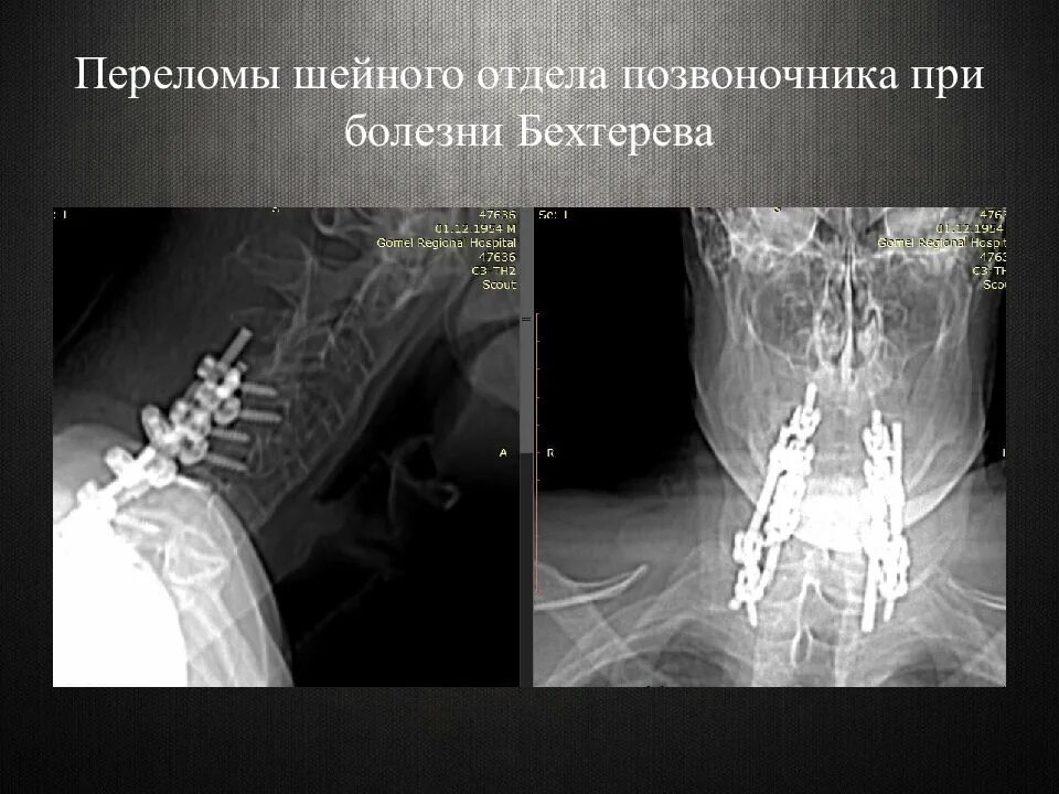 Перелом шейного отдела позвоночника. Перелом позвонка шейного отдела. Перелом позвонков шейного отдела позвоночника. Травматический перелом позвонков. Осложнения перелома позвоночника