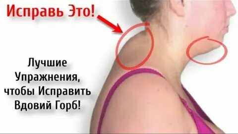 Вдовий горб липосакция отзывы