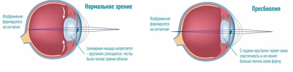 Изображение пропадает если оно расположено впереди сетчатки. Пресбиопия симптомы. Пресбиопия это в офтальмологии. Хрусталик глаза пресбиопия.