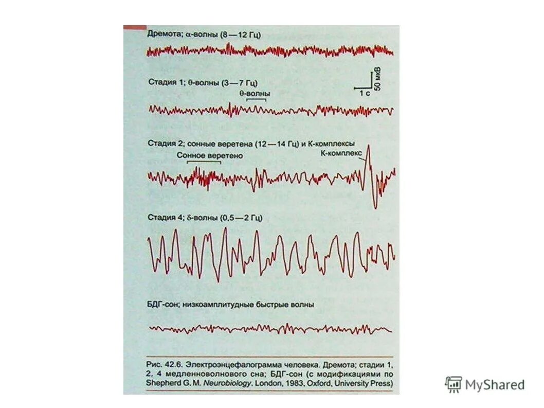 K комплексы на ээг. Сонные веретена на ээг норма. Сонные веретена и к-комплексы на ээг. Сонные веретена и к-комплексы на ээг. Сонные веретена и к-комплексы на ээг.