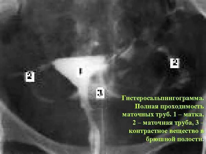 Операция проходимость труб. Непроходимость маточных труб УЗИ. Рентген ГСГ маточных труб описание. Метросальпингография маточных труб. Маточные трубы рентген норма.