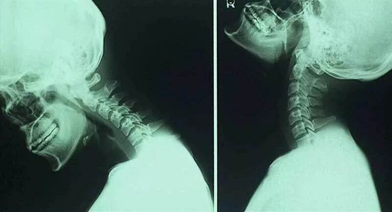 Гипермобильность с4 с5 сегмента шейного отдела позвоночника. Нестабильность с2-с3 шейного отдела. Гипермобильность шейного отдела позвоночника рентген. Неустойчивость шейных позвонков. Нестабильность шейных позвонков у взрослого.