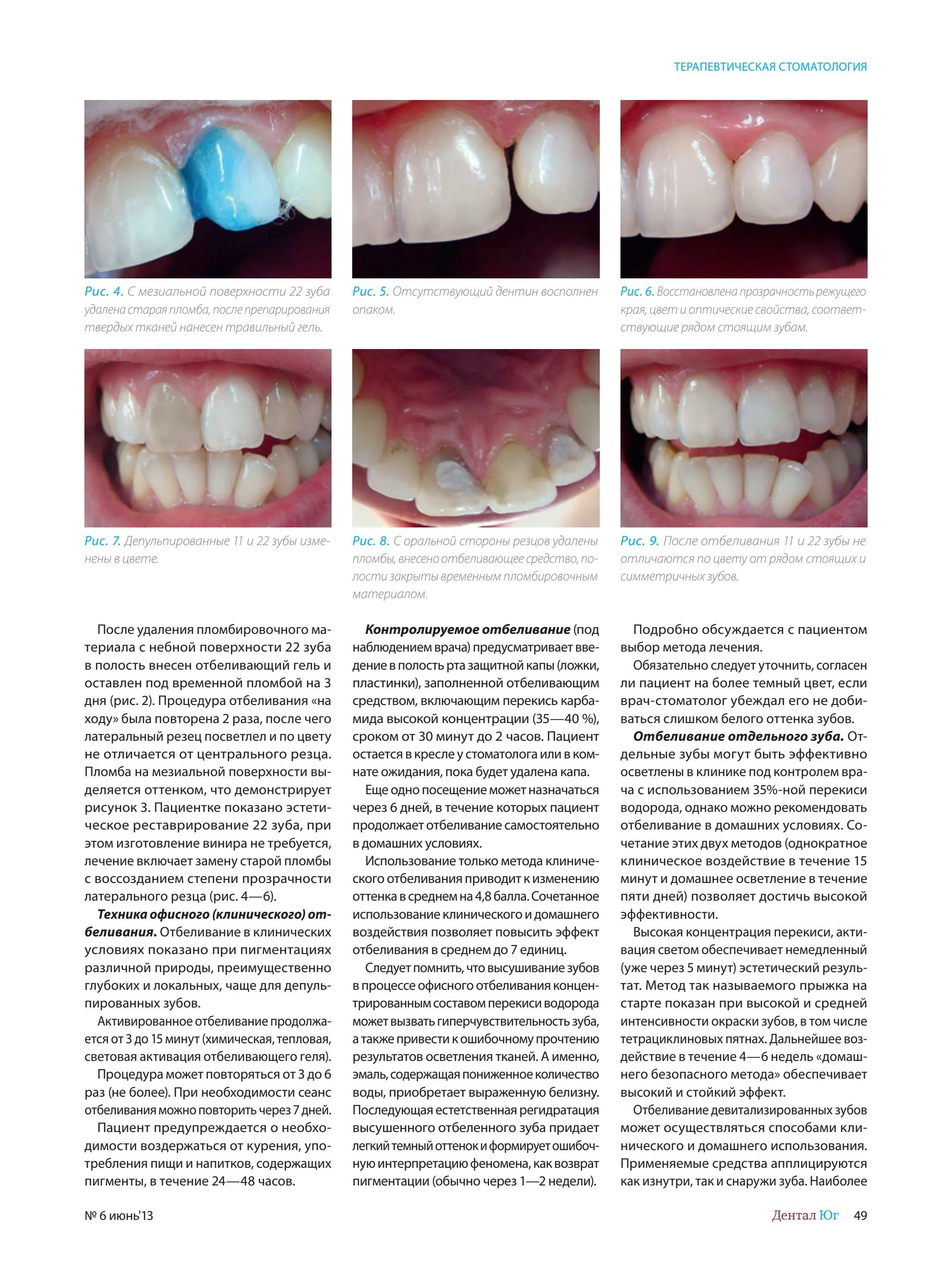 Можно ли есть зубы. Терапевтическая стоматология пломба. Пломба две поверхности зуба в стоматологии. Пломба для зубов для осветления.