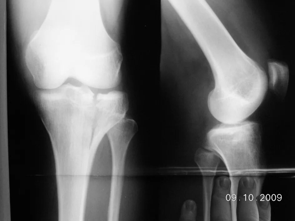 Перелом мыщелка берцовой кости. Перелом наружного мыщелка большеберцовой кости рентген. Перелом мыщелков большеберцовой кости рентген. Импрессионный перелом мыщелка большеберцовой кости.