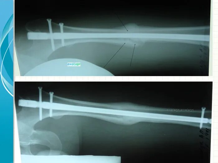 Что такое консолидация перелома. Консолидация перелома рентген. Стадии консолидации перелома на рентгене. Консолидированный перелом рентген. Замедленная консолидация переломов.