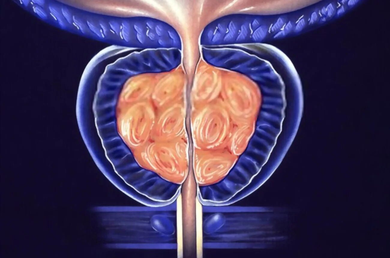Аденома предстательной железы. Воспаление предстательной железы. Нарушение предстательной железы