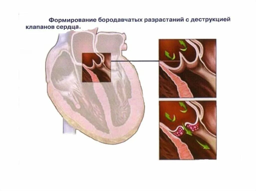 Эндокардит патологическая анатомия. Инфекционный септический эндокардит патанатомия. Эндокардит Либмана Сакса. Вегетация сердца