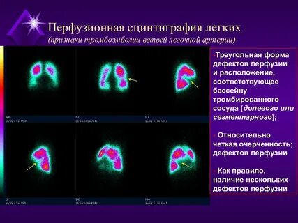 Сцинтиграфия
