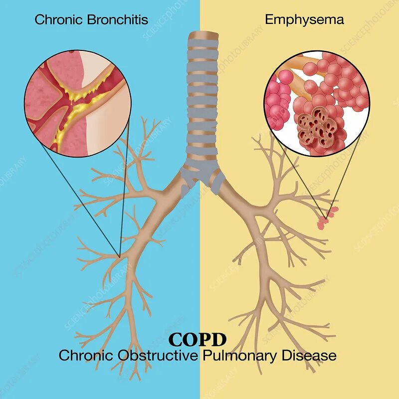 Pulmonary disease. Хроническая обструктивная болезнь легких. О болезнях легких презентация. Pulmonary disease. Pulmonary disease.