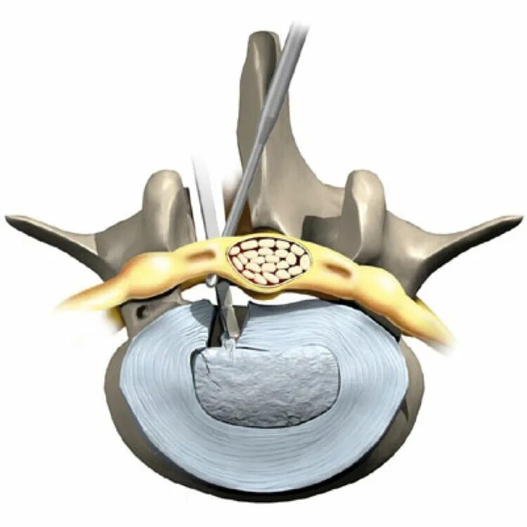 Дискэктомия поясничного отдела позвоночника. Микродискэктомия грыжи позвоночника. Стеноз позвоночного канала операция.