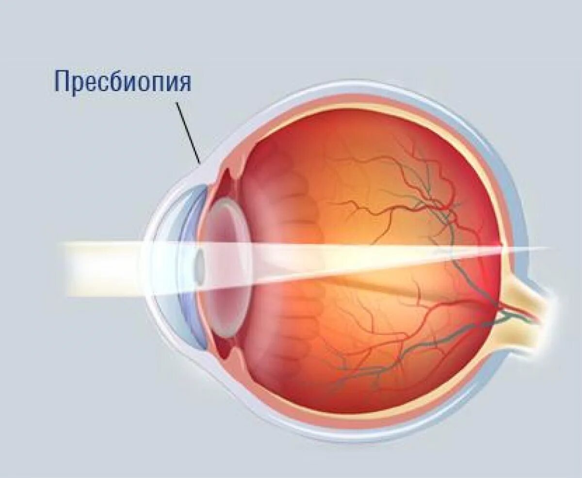 Хрусталики в глазах что это