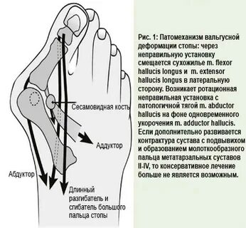 Вальгусная стопа у взрослых операция