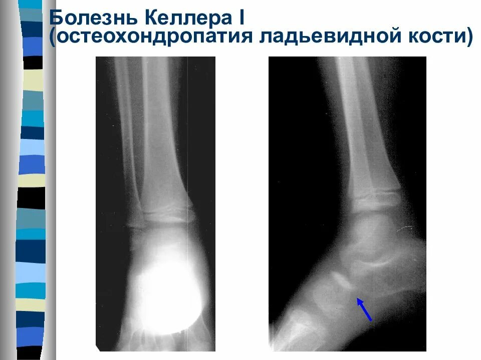 Остеохондропатия головки плюсневой кости. Болезнь Келлера ладьевидной кости. Остеохондропатия плюсневых костей. Остеохондропатия ладьевидной кости стопы рентген.