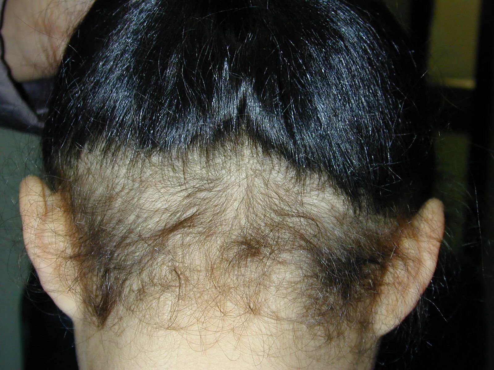 Сифилитическая алопеция (облысение). Очаговая алопеция (alopecia areata). Гнёздная (очаговая алопеция). Очаговая алопеция (alopecia areata). Очаговая алопеция лентовидная.