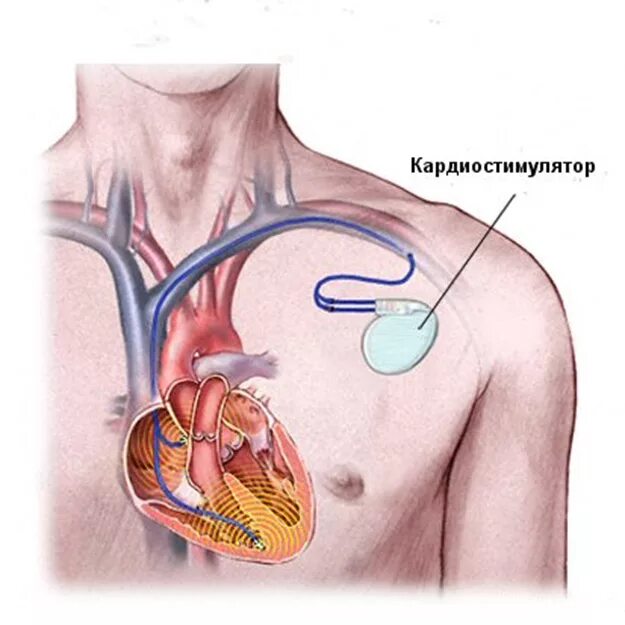 Кардиовертер дефибриллятор операция. Кардиостимулятор сердца. Электрокардиостимулятор имплантируемый. Кардиовертер-дефибриллятор на человеке. Почему в инструкции людям с кардиостимуляторами запрещается