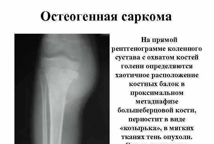 Как выглядит рак кости на ноге Саркома Јуинга Опухоль кости Опис, дијагностика, лечење болести