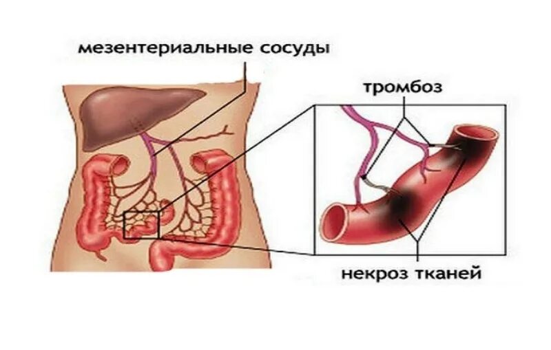 Тромбоз сосудов брыжейки. Тромбоз мезентериальных артерий. Мезентериальный тромбоз кишечника. Тромбоэмболия мезентериальных артерий клиника. Острый мезентериальный тромбоз