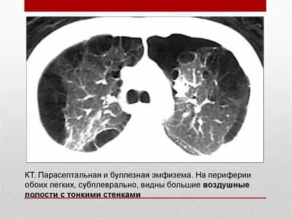 Исчезающее легкое