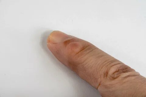 Bulto en el dedo de la mano: Causas y tratamiento. 