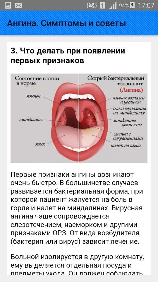 Острый бактериальный тонзиллит. Бактериальная ангина у ребенка симптомы. Вирусная и бактериальная ангина у детей.