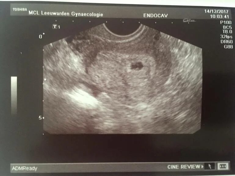 Узи после криопереноса. Эмбрион в матке после переноса на УЗИ. УЗИ после переноса эмбрионов. Первое УЗИ после подсадки. Снимки УЗИ беременности.