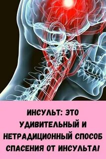 Инсульт позвоночника