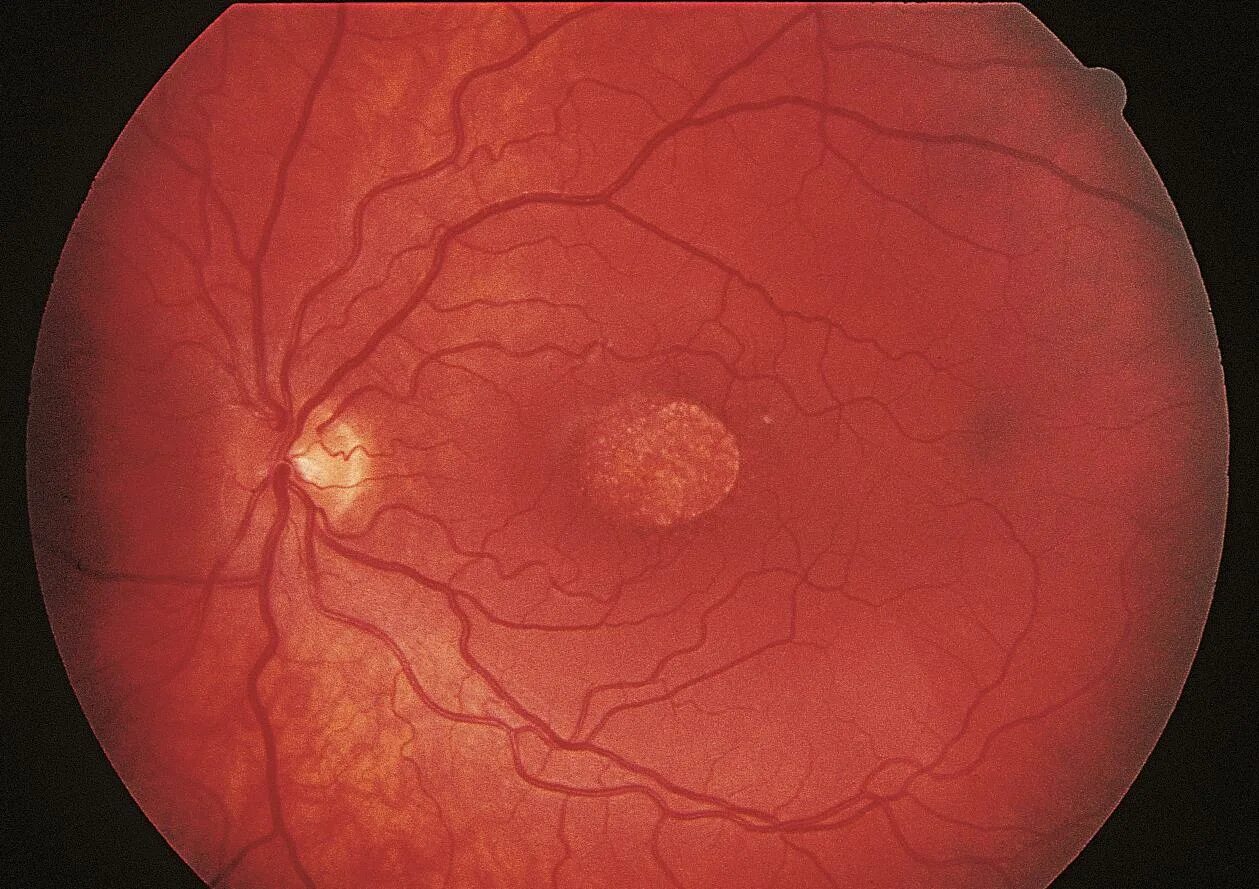 Диабетическая ретинопатия глазное дно. Почечная гипертоническая ретинопатия. Гипертоническая ангиопатия и ретинопатия. Альбуминурическая ретинопатия. Изменение на глазном дне
