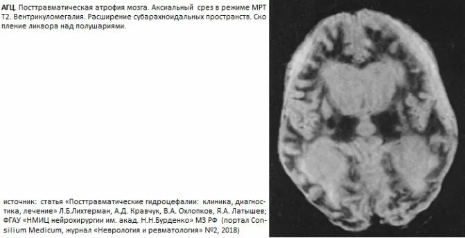 Умеренно расширение конвекситальных пространств