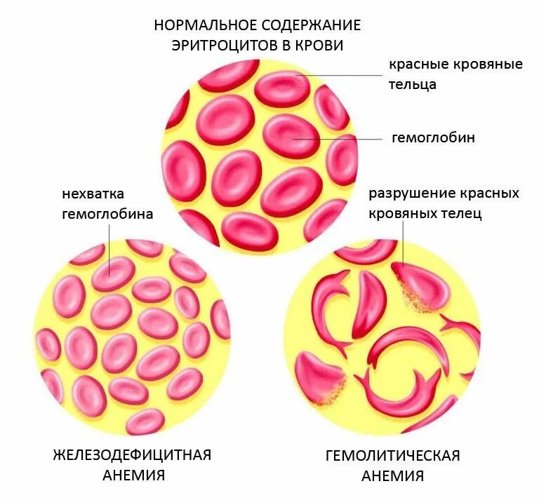 При каком заболевании эритроцитов. Железодефицитная анемия эритроциты форма. Эритроциты при жда. Эритроциты при анемии. Железодефицитная анемия Эрит.