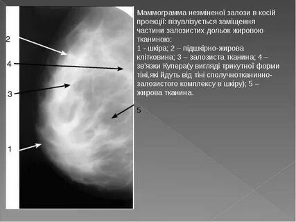 Маммограмма это