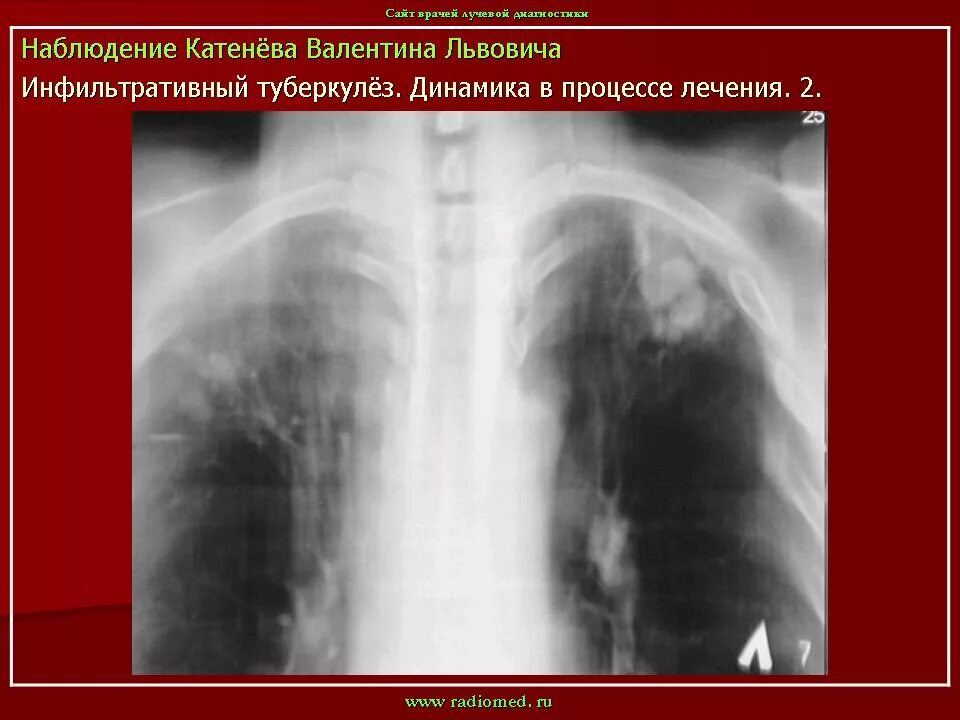 Фаза распада легких. Инфильтративный туберкулез в фазе обсеменения рентген. Бронхолобулярный инфильтративный туберкулез рентген. Бронхолобулярный инфильтративный туберкулез кт. Инфильтративный туберкулез в фазе распада и обсеменения кт.