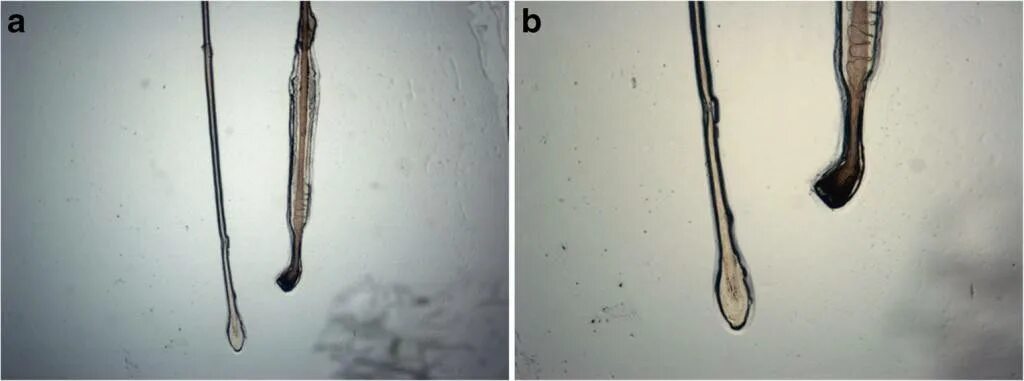Волосяная луковица в телогене. Луковица волоса под микроскопом. Корень волоса под микроскопом. Черная волосяная луковица.