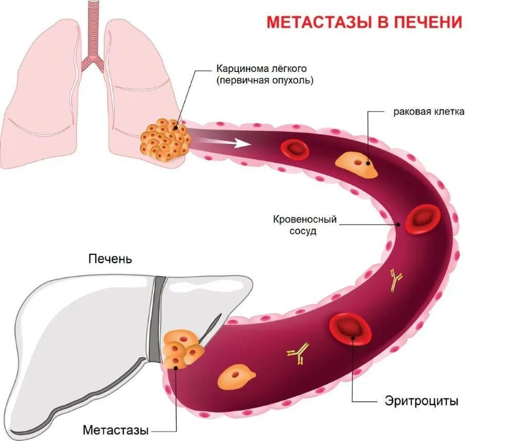 Метастазы в печени лечение. Метастазы в печени лечение