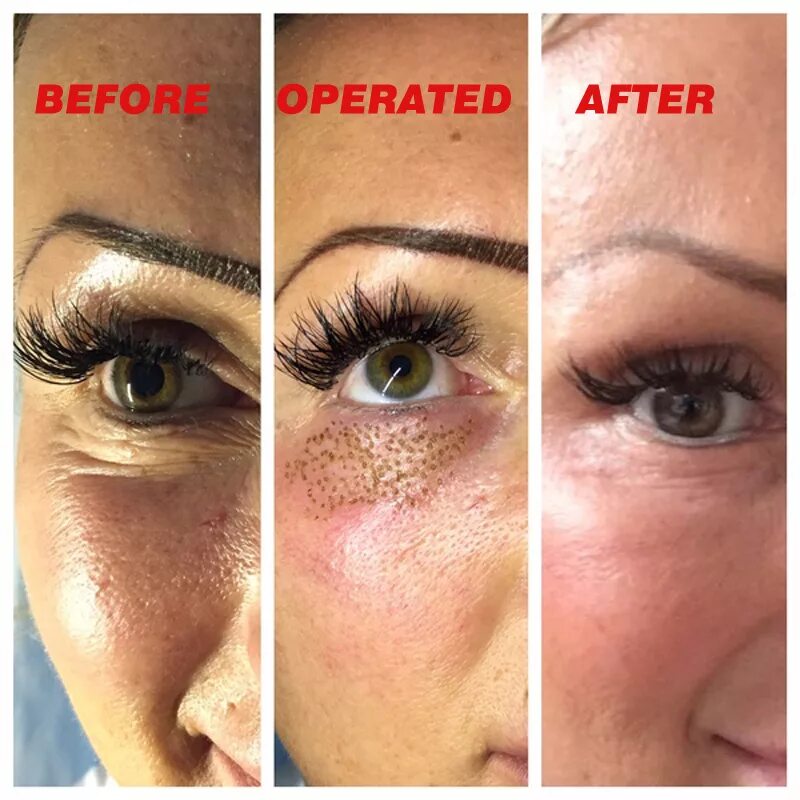 Плазма пен подтяжка век. Плазма лайнер аппарат. Холодная плазма глаза. Холодная плазма глаза. Плазменное омоложение верхних век.