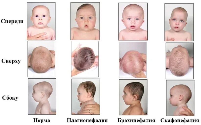 Форма головы сбоку младенца. Форма черепа у детей до года правильная. Кривошея плагиоцефалия. Правильная форма головы у грудничка 3 месяца.