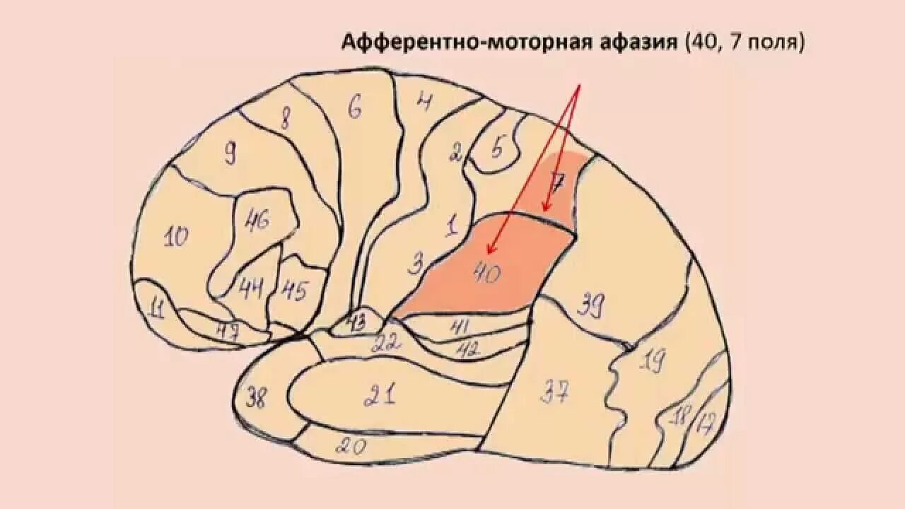 Афазия сенсорная моторная динамическая. Афферентная сенсорная. Сенсорная афазия зона поражения. Афферентная и эфферентная афазия. Сенсорная корковая афазия брока-вернике.
