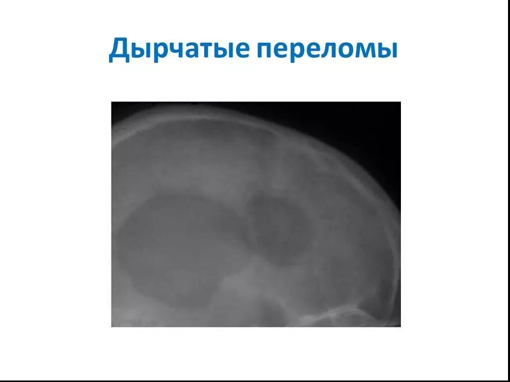 Оскольчатый перелом черепа. Дырчатый перелом черепа. дырчатый перелом костей черепа рентген. дырчатый перелом свода черепа. террасовидный перелом костей черепа.